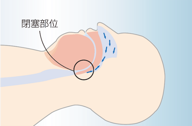 CPAP(Continuous Positive Airway Pressure)療法