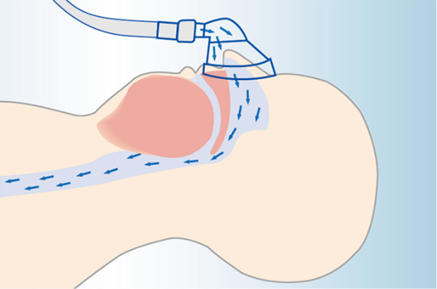 CPAP(Continuous Positive Airway Pressure)療法